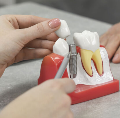 Hamilton dentist dental implant model