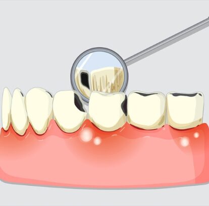 Dental Fillings: Understanding the Options Available