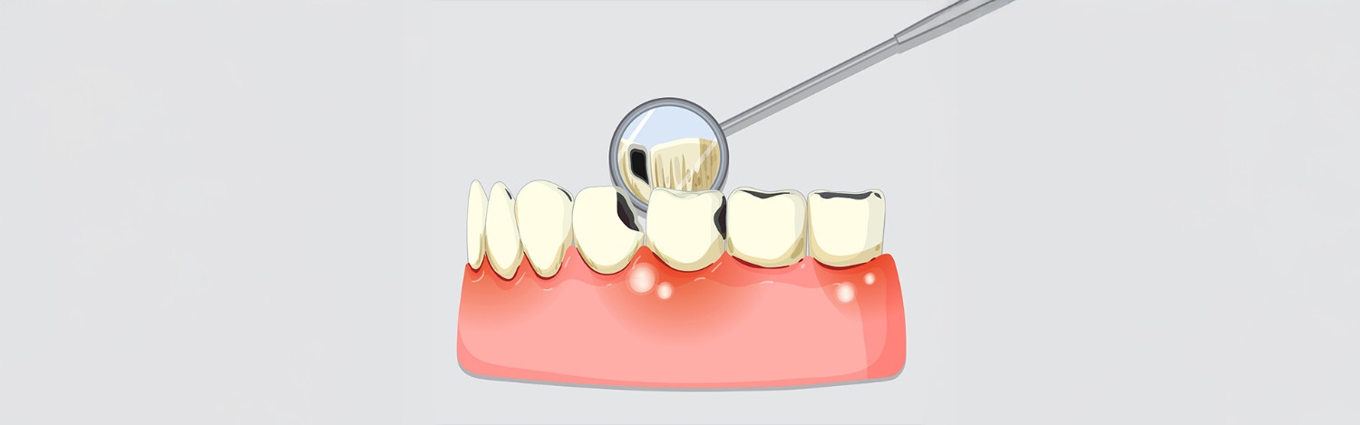 Dental Fillings: Understanding the Options Available